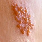 оперізуючий лишай