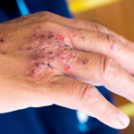 стрептодермия