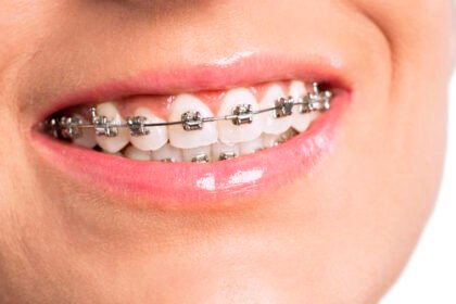 брекети